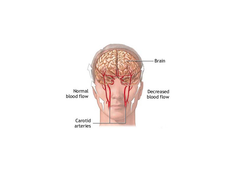 Hjernen: Kan Kaatsu beskytte hjernen? Hjernen er her vist med forskelligt blood flow. Kaatsu er også kendt som blood flow restriction (BFR), som modererer blodgennemstrømningen. Dette har vist sig at have positiv indvirkning på hjernen